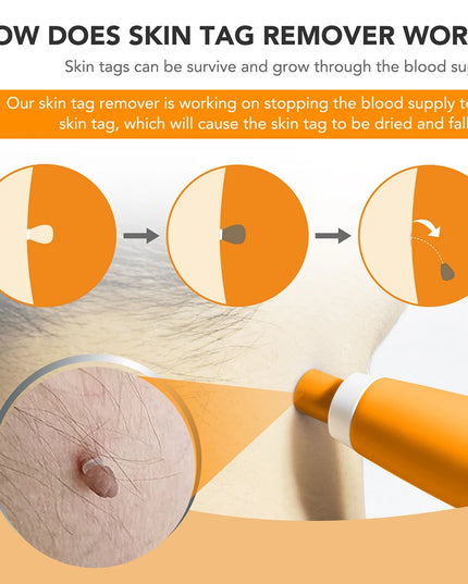 Skin Tag Removal Device Face Beauty Accessories Rubber Rings Wart Tag Remover Kit Multipurpose Supplies for Face Neck Chin Back